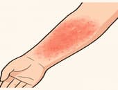 アトピー性皮膚炎